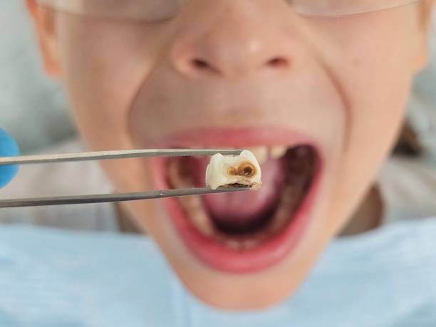 Best Emergency Treatment for Toothache in Nitro, WV